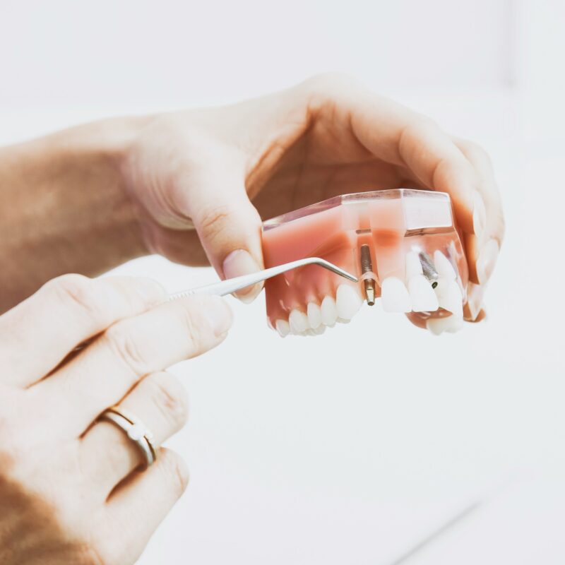 Implantes dentales en Madrid