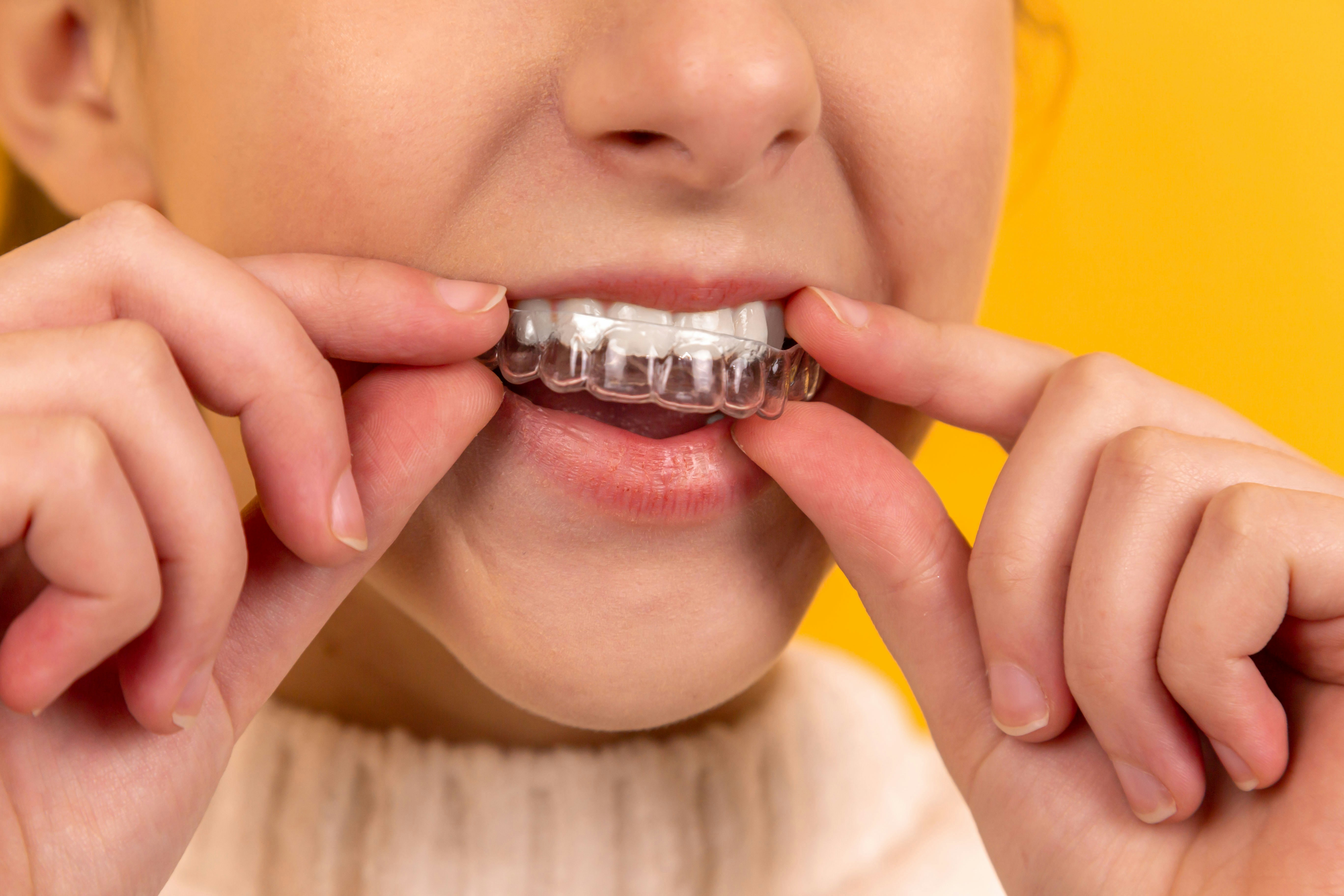 Blanqueamiento dental en Madrid