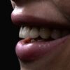 Blanqueamiento dental en Madrid