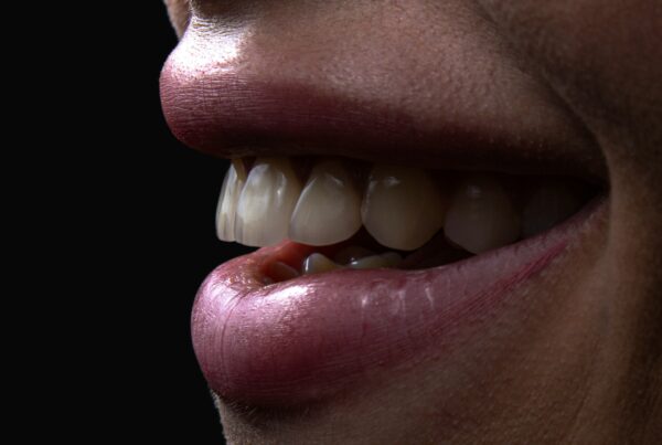 Blanqueamiento dental en Madrid