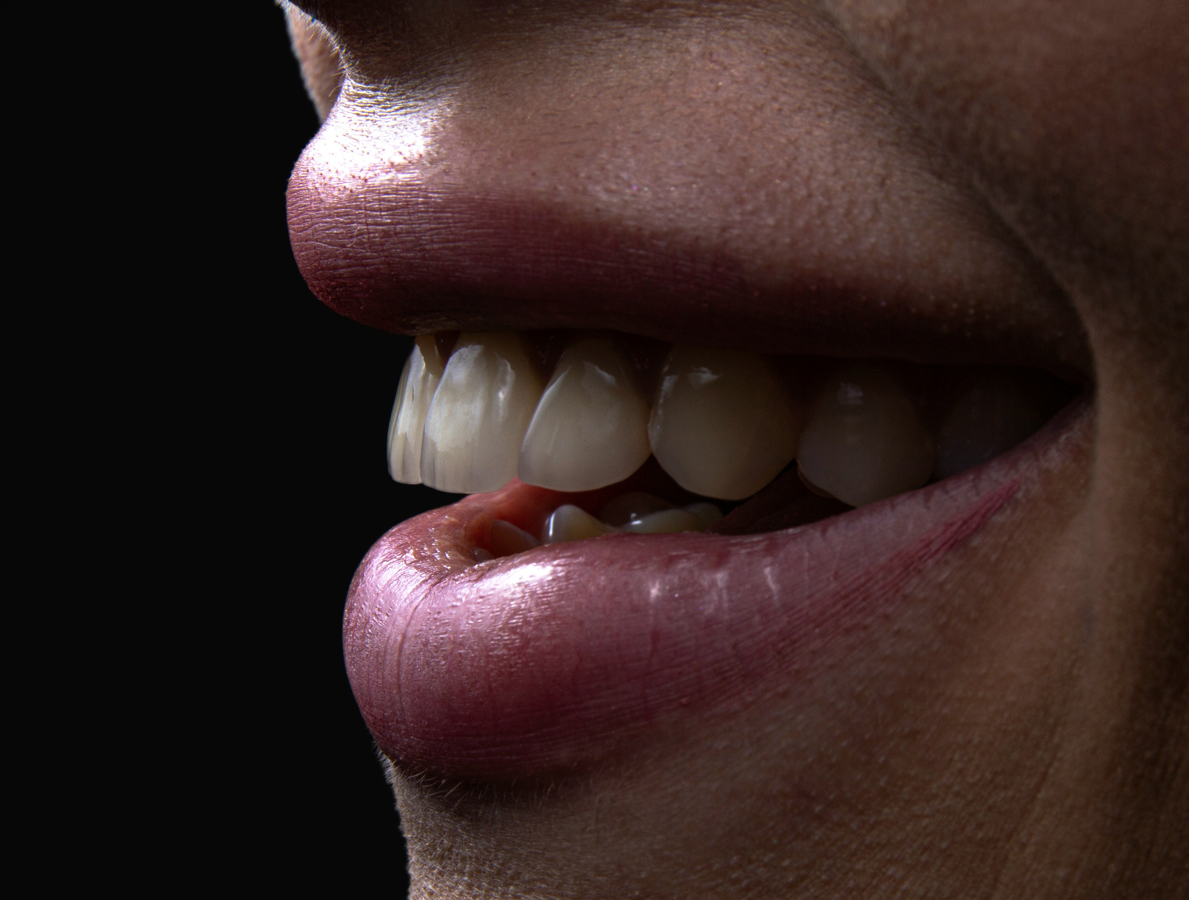 Blanqueamiento dental en Madrid