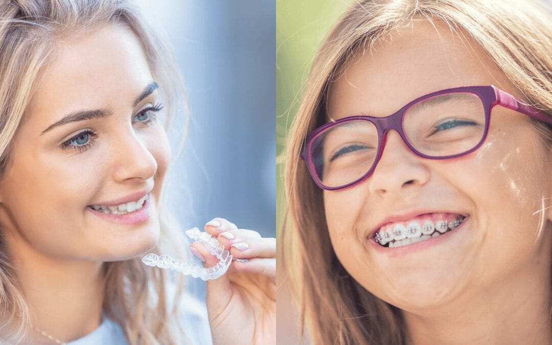 Brackets o Invisalign