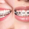 Brackets o Invisalign