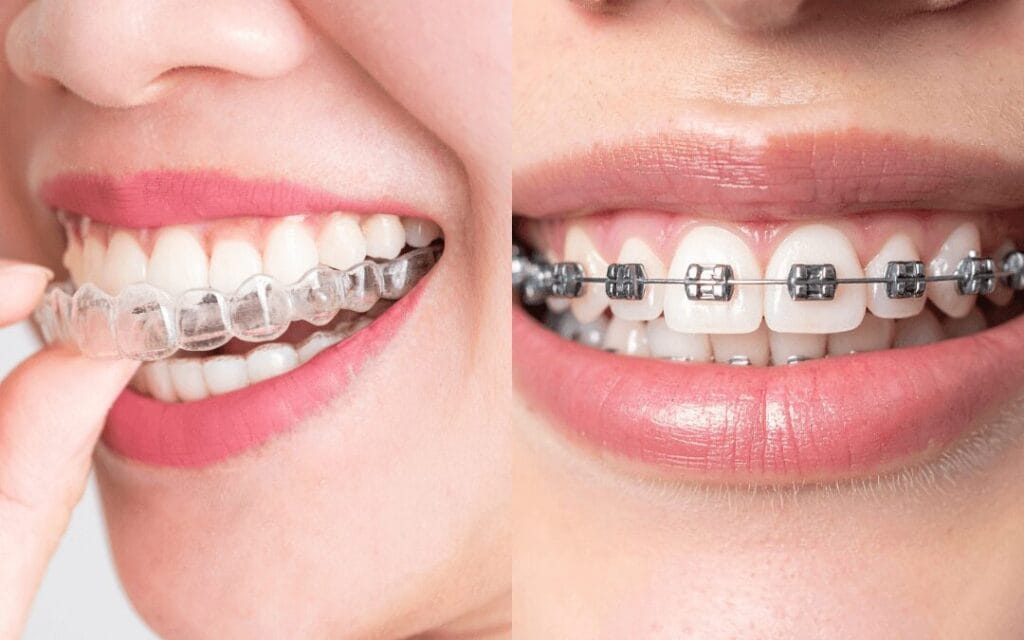 Brackets o Invisalign