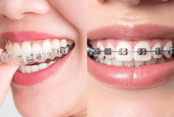 Brackets o Invisalign