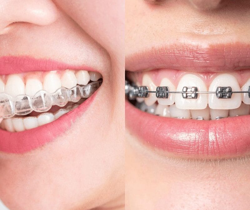 Brackets o Invisalign