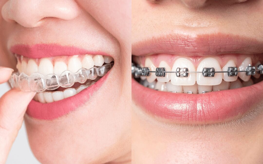 ¿Brackets o Invisalign? Cómo elegir tu tratamiento de ortodoncia