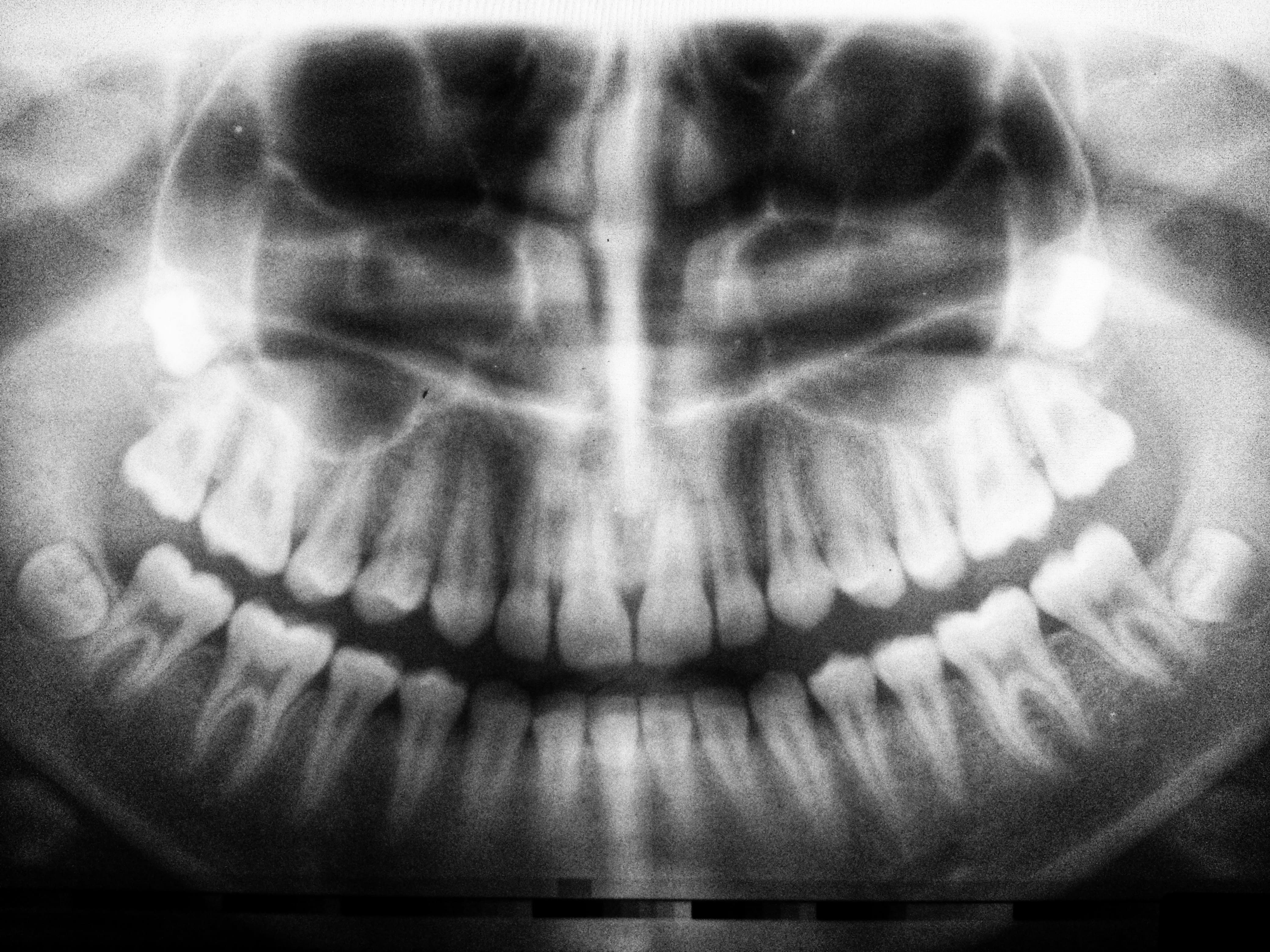 endodoncia en madrid