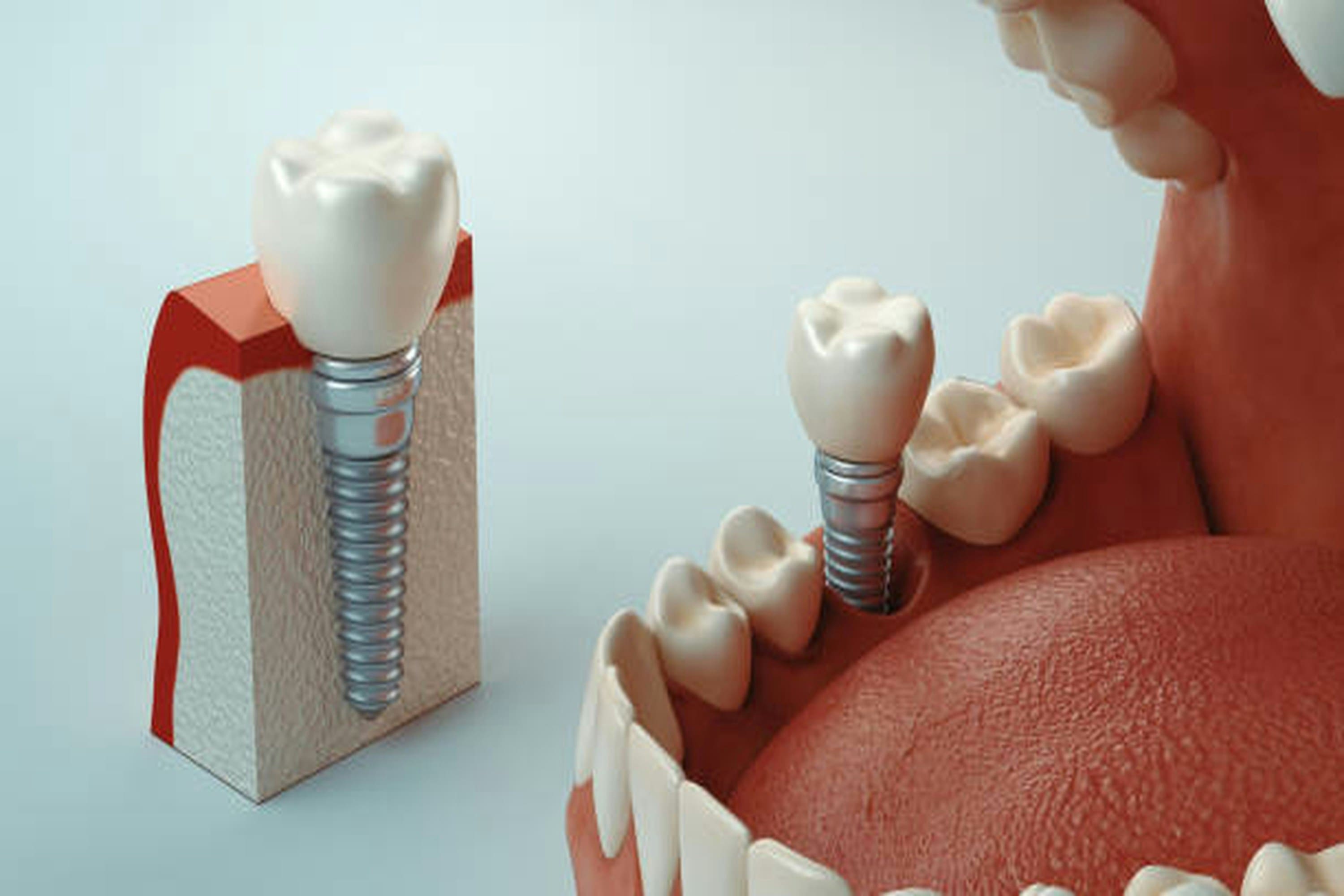 implantes dentales chamberi