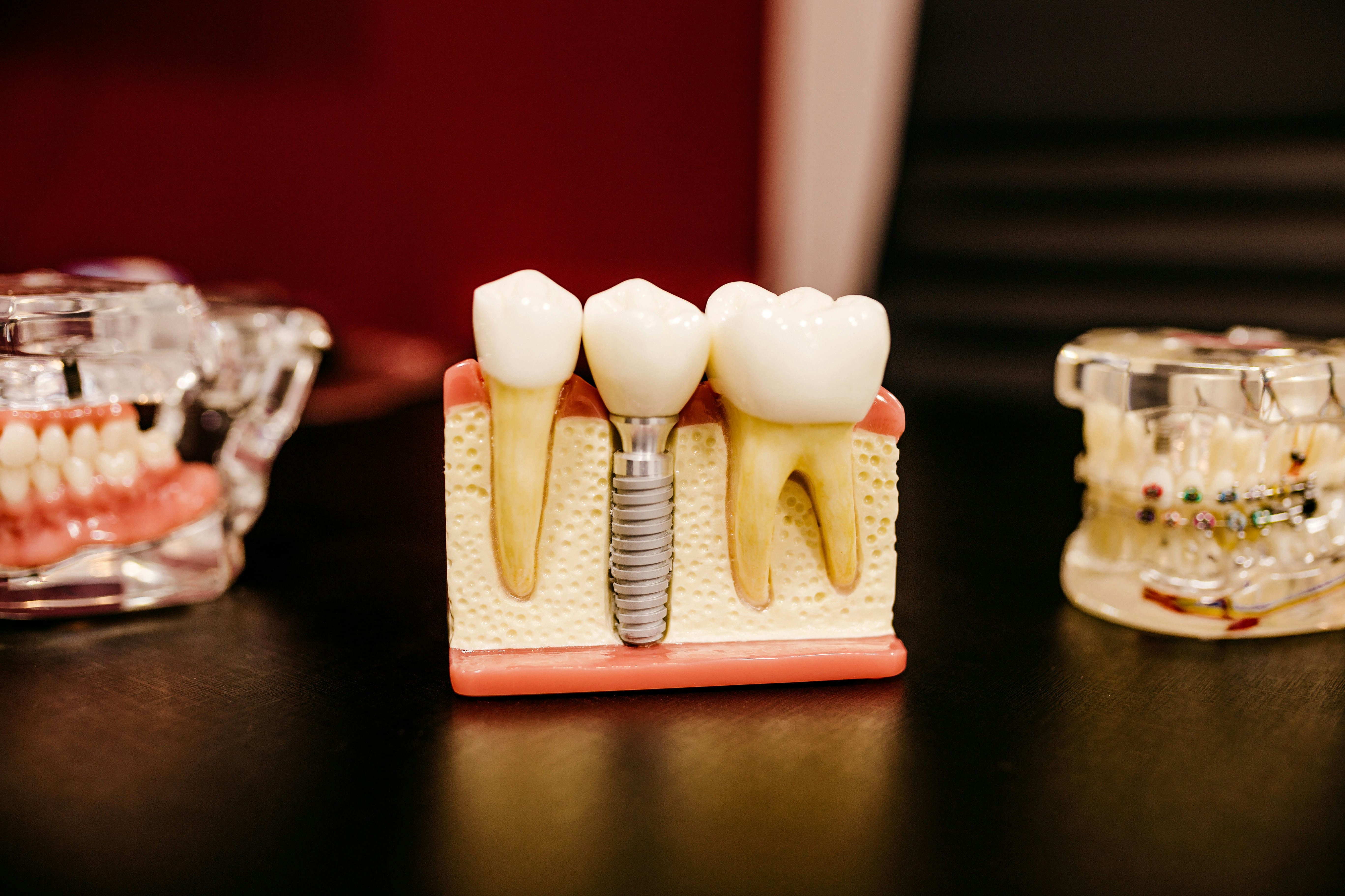 implantes dentales Chamberí